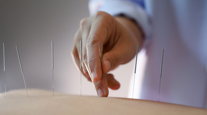 Acupuncture