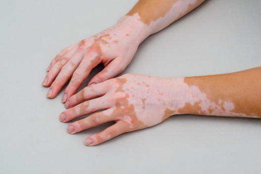 Vitiligo/Leucoderma
